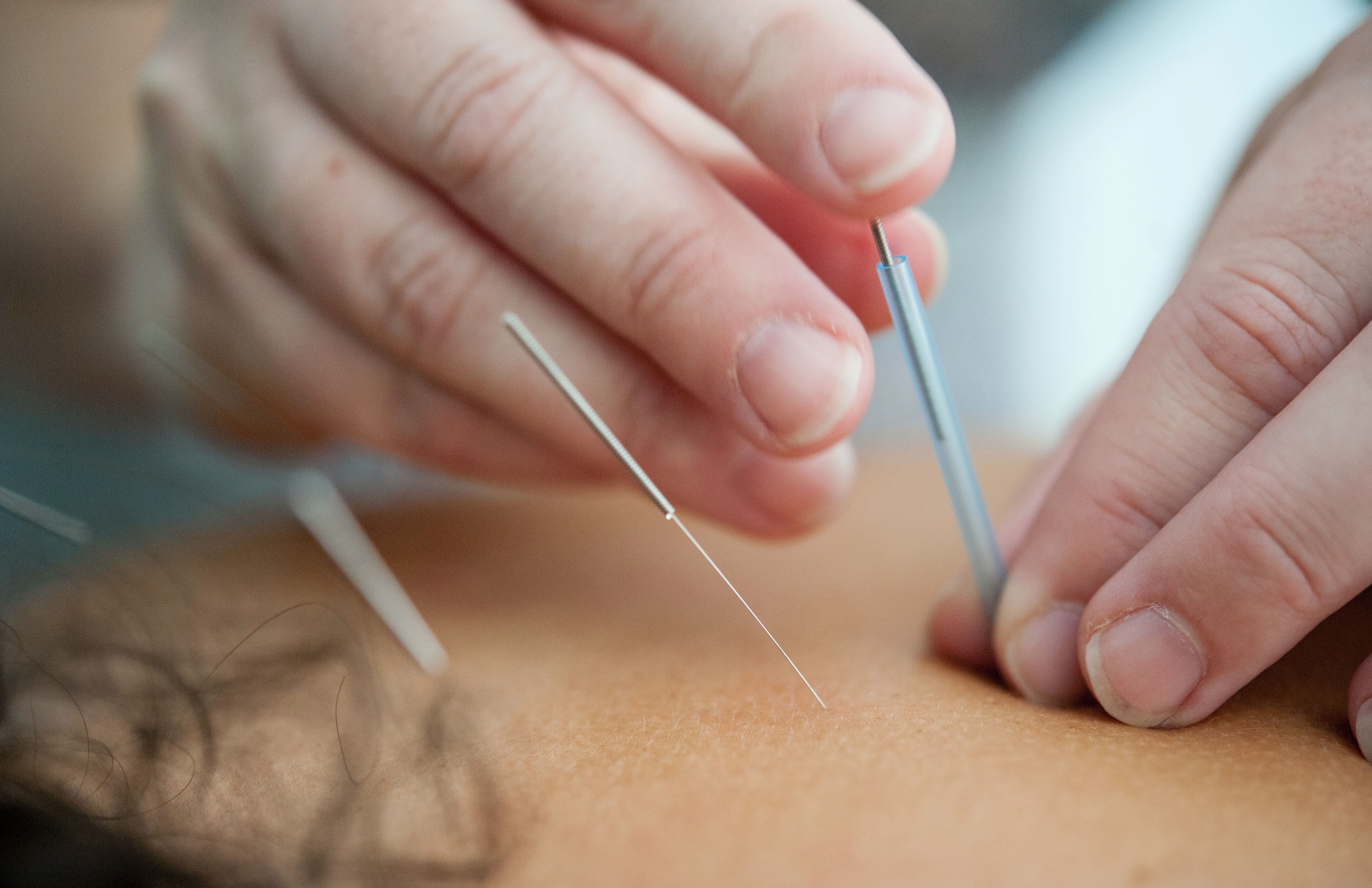 5 raisons de choisir une mutuelle prenant en charge les soins d’acupuncture